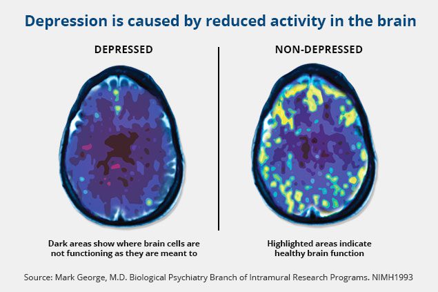 depression is caused by reduced activity in the brain - brain activity and TMS therapy